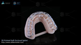 Bruxism আরাম জন্য কাস্টম 3D মুদ্রিত স্প্লিন্ট