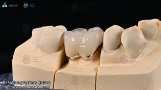 Feldspathic Veneers ন্যাচারাল স্মাইল মেকওভার গাইড