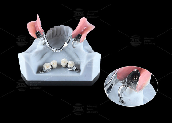 0.1mm Tolerance CEKA REVAX সংযুক্তি টাইটানিয়াম 3mm উল্লম্ব ক্লিয়ারেন্স