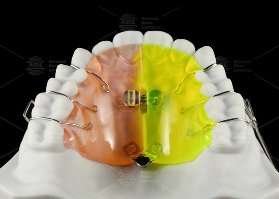 Orthodontic ফ্যান আকৃতির এক্সপ্যান্ডার পিছনের ক্রসবিট মুক্ত বিভাগ সম্প্রসারণ প্রদান করে