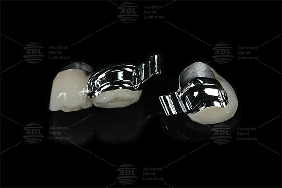 চায়না ডেন্টাল ল্যাব অ্যাডজাস্টেবল পেশেন্ট স্পেসিফিক কিওয়ে প্রিসিশন অ্যাটাচমেন্ট উইথ PFM