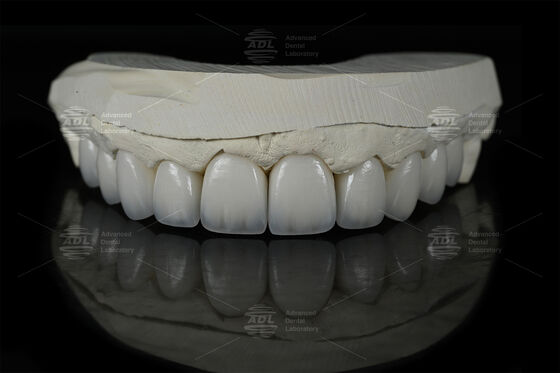 0.3mm-0.7mm ফিল্ডস্পেথিক ইএমইএক্স সিরামিক ফিনিয়ার প্রাকৃতিক নান্দনিক ইএমইএক্স ডেন্টাল ফিনিয়ার
